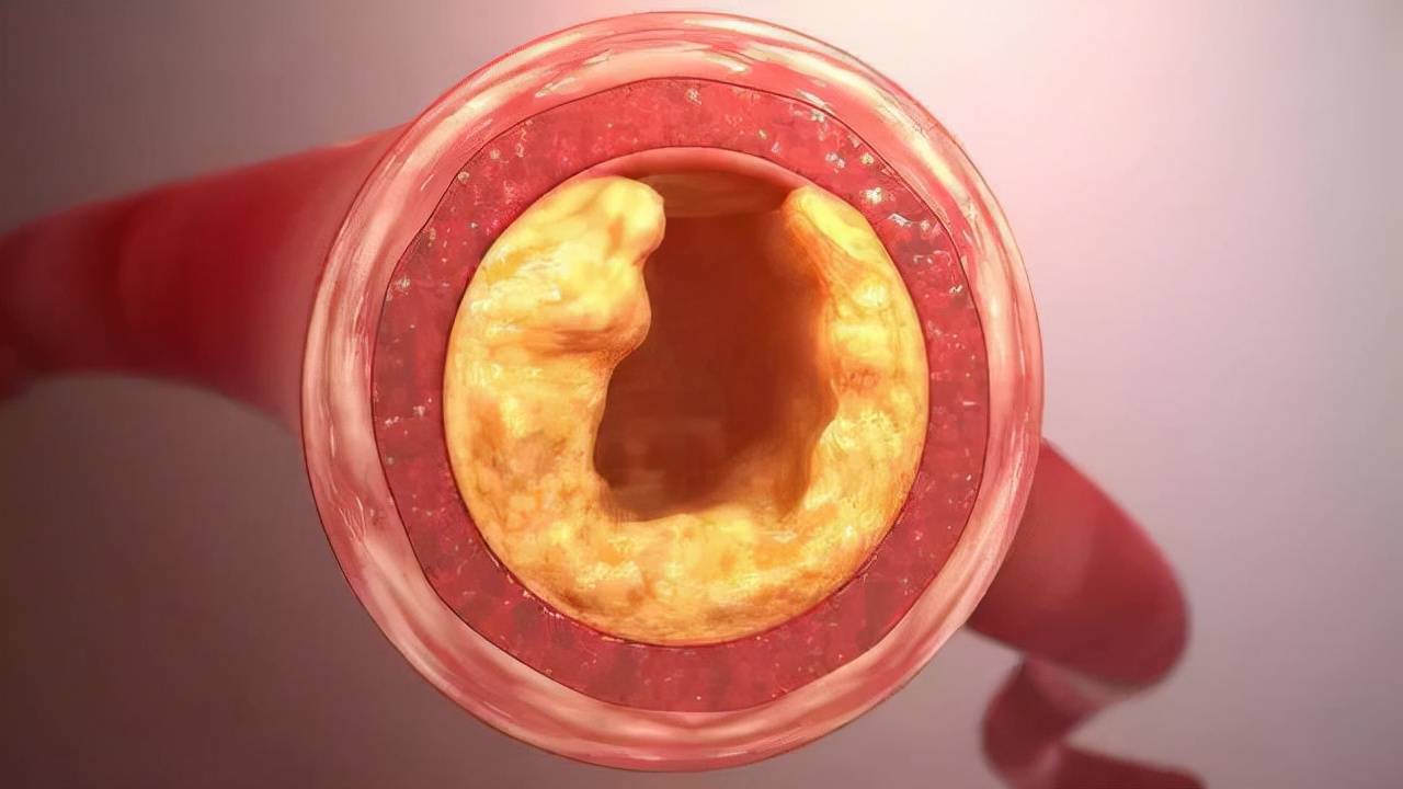 甘油三酯多少为正常范围才算高 甘油三酯最怕三样水果 甘油三酯多少为正常范围才算高 甘油三酯最怕三样水果